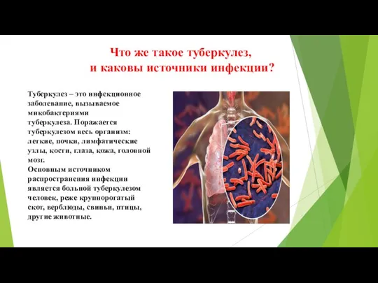 Туберкулез – это инфекционное заболевание, вызываемое микобактериями туберкулеза. Поражается туберкулезом весь