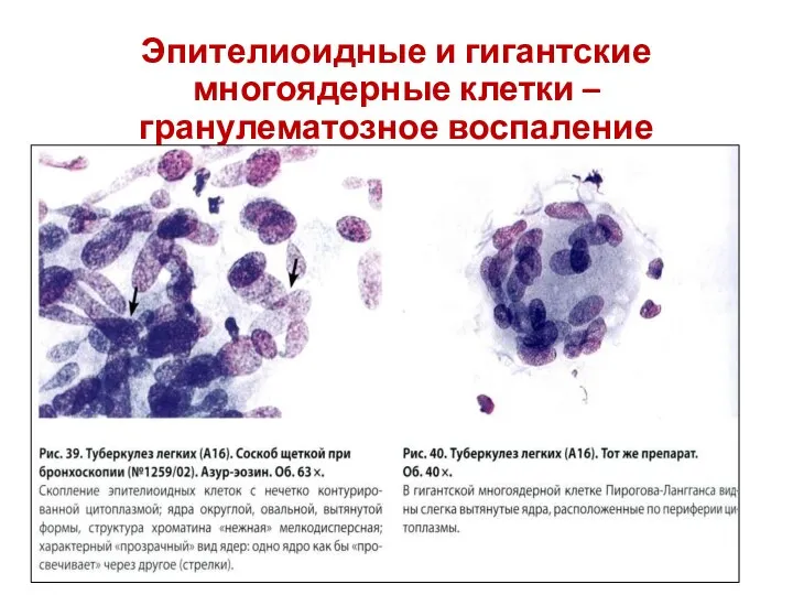 Эпителиоидные и гигантские многоядерные клетки – гранулематозное воспаление