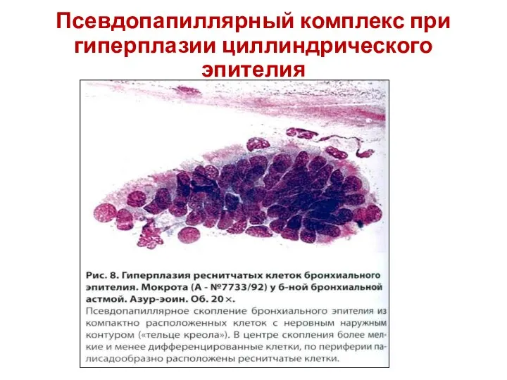 Псевдопапиллярный комплекс при гиперплазии циллиндрического эпителия