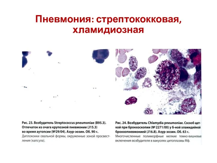 Пневмония: стрептококковая, хламидиозная