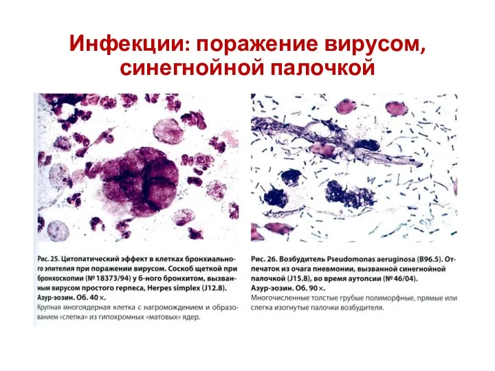 Инфекции: поражение вирусом, синегнойной палочкой