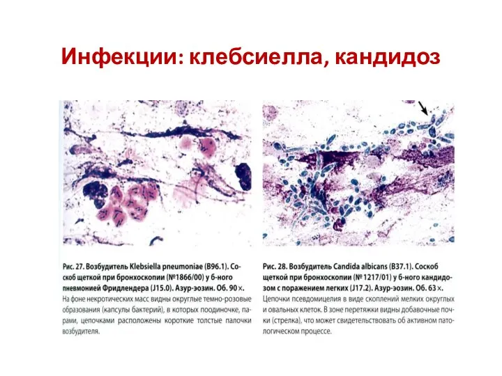 Инфекции: клебсиелла, кандидоз