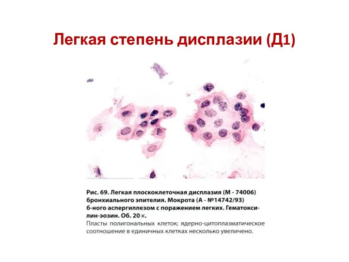 Легкая степень дисплазии (Д1)