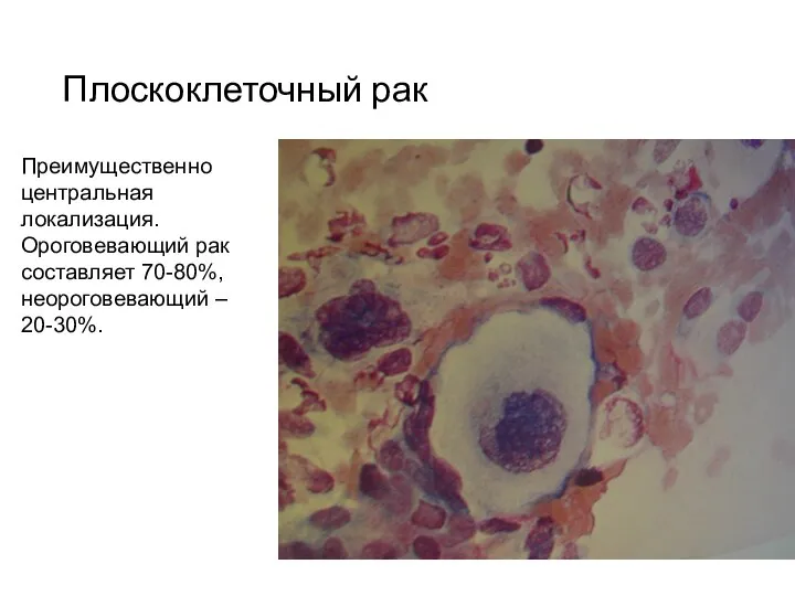 Плоскоклеточный рак Преимущественно центральная локализация. Ороговевающий рак составляет 70-80%, неороговевающий – 20-30%.