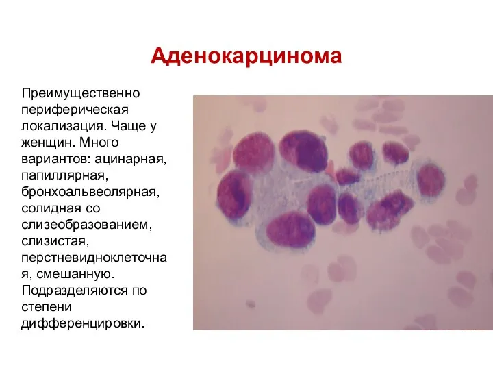 Аденокарцинома Преимущественно периферическая локализация. Чаще у женщин. Много вариантов: ацинарная, папиллярная,