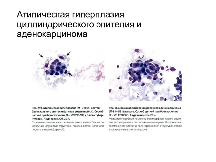 Атипическая гиперплазия циллиндрического эпителия и аденокарцинома