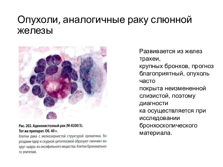 Опухоли, аналогичные раку слюнной железы Развивается из желез трахеи, крупных бронхов,