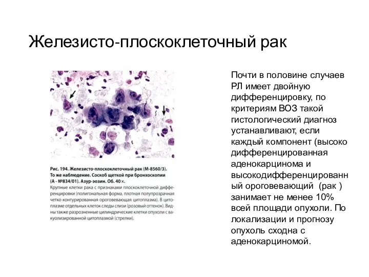 Железисто-плоскоклеточный рак Почти в половине случаев РЛ имеет двойную дифференцировку, по