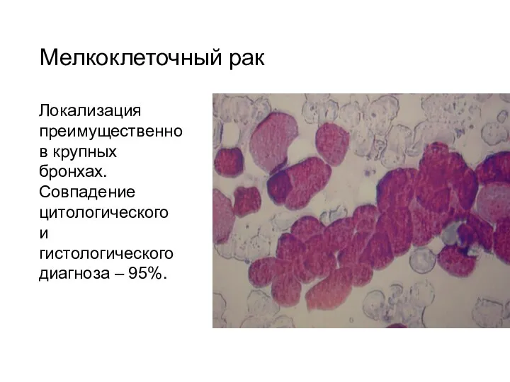 Мелкоклеточный рак Локализация преимущественно в крупных бронхах. Совпадение цитологического и гистологического диагноза – 95%.