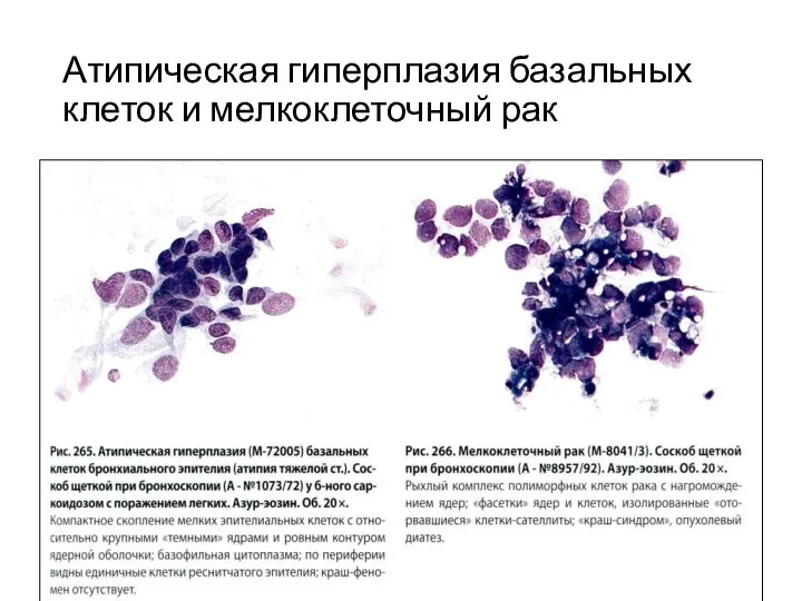 Атипическая гиперплазия базальных клеток и мелкоклеточный рак