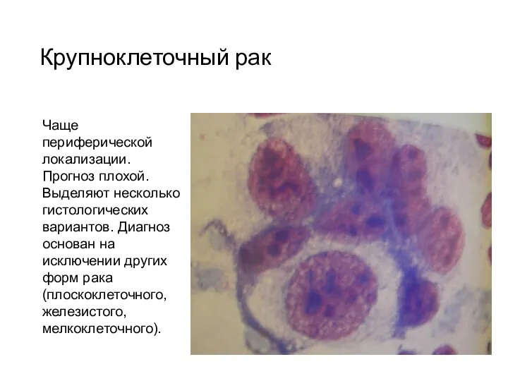 Крупноклеточный рак Чаще периферической локализации. Прогноз плохой. Выделяют несколько гистологических вариантов.