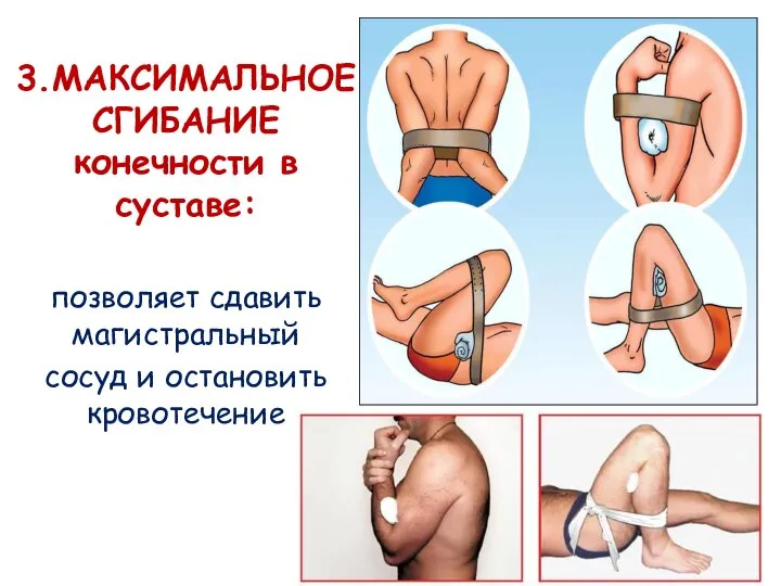 3.МАКСИМАЛЬНОЕ СГИБАНИЕ конечности в суставе: позволяет сдавить магистральный сосуд и остановить кровотечение