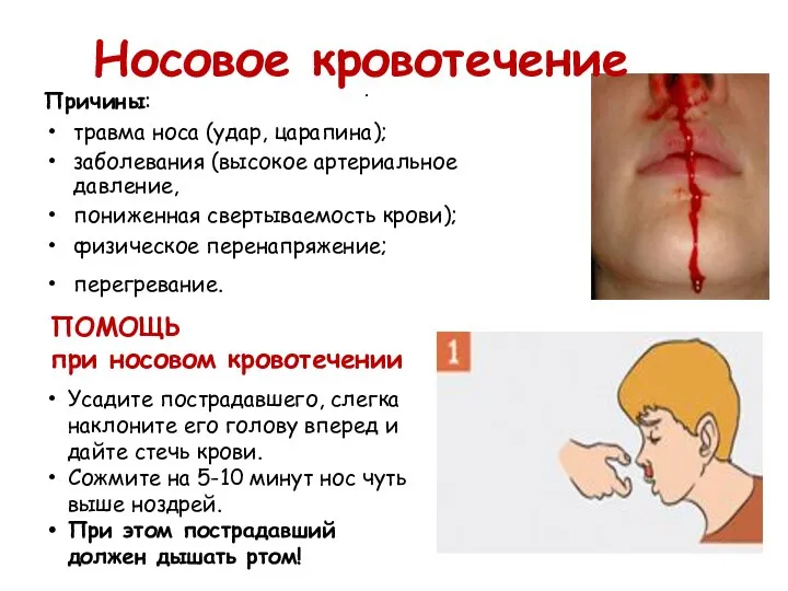 . Носовое кровотечение Причины: травма носа (удар, царапина); заболевания (высокое артериальное