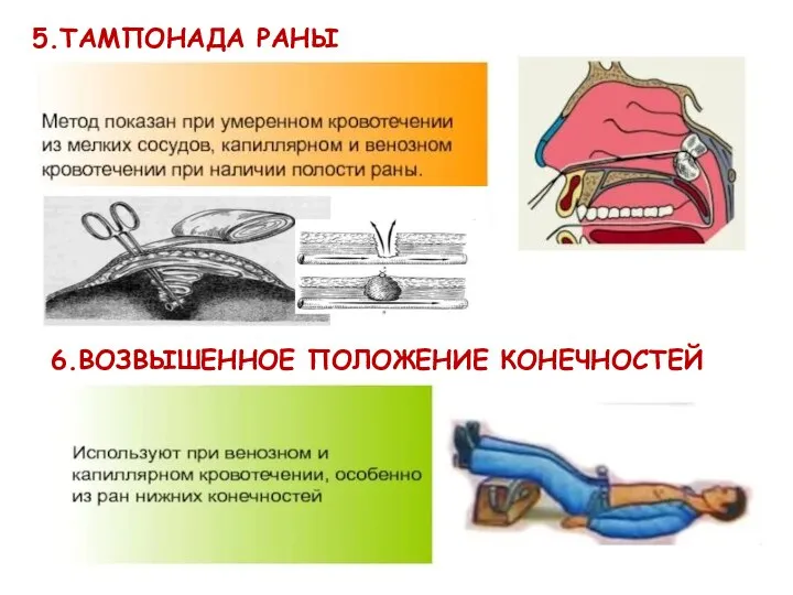 5.ТАМПОНАДА РАНЫ 6.ВОЗВЫШЕННОЕ ПОЛОЖЕНИЕ КОНЕЧНОСТЕЙ