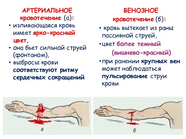 ВЕНОЗНОЕ кровотечение (б): кровь вытекает из раны пассивной струей, цвет более