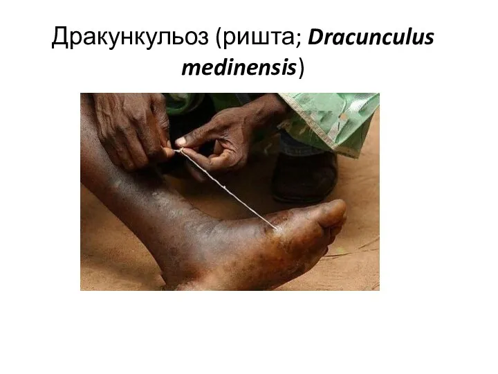 Дракункульоз (ришта; Dracunculus medinensis)