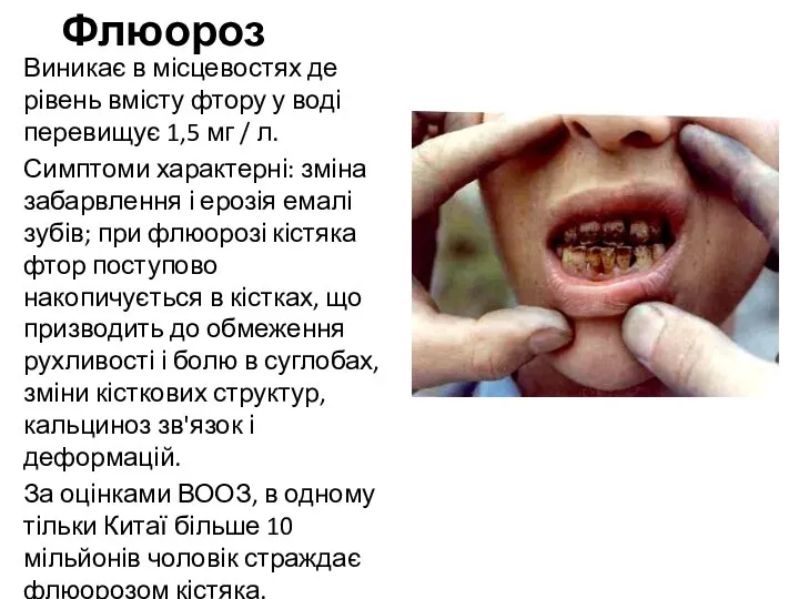 Флюороз Виникає в місцевостях де рівень вмісту фтору у воді перевищує