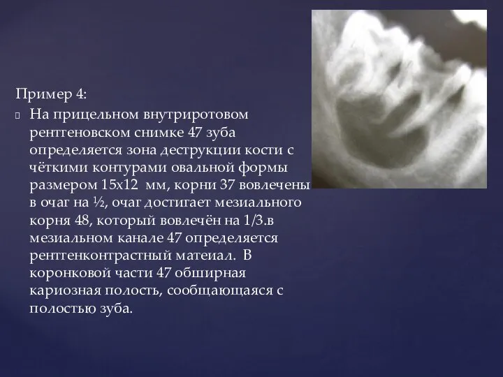 Пример 4: На прицельном внутриротовом рентгеновском снимке 47 зуба определяется зона