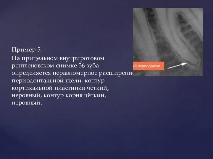 Пример 5: На прицельном внутриротовом рентгеновском снимке 36 зуба определяется неравномерное