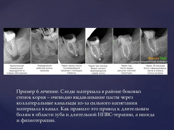 Пример 6 лечение. Следы материала в районе боковых стенок корня –