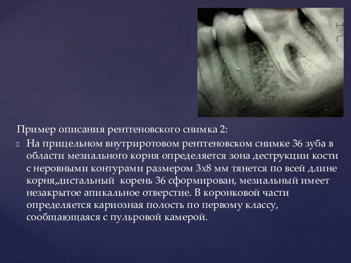 Пример описания рентгеновского снимка 2: На прицельном внутриротовом рентгеновском снимке 36