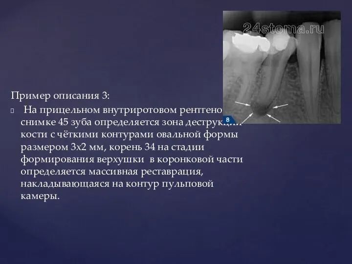 Пример описания 3: На прицельном внутриротовом рентгеновском снимке 45 зуба определяется