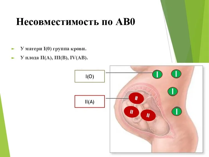 Несовместимость по АВ0 У матери I(0) группа крови. У плода II(А),