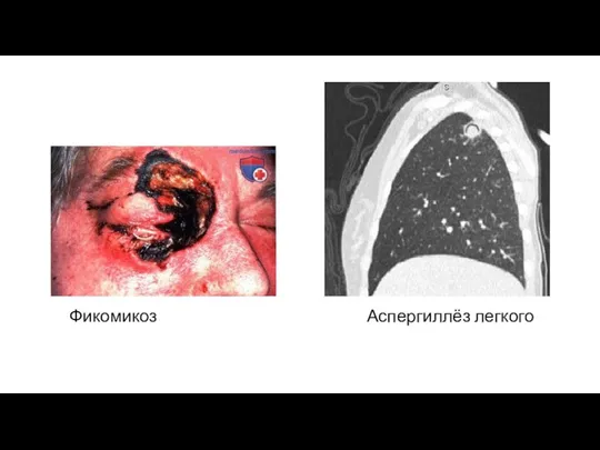 Фикомикоз Аспергиллёз легкого