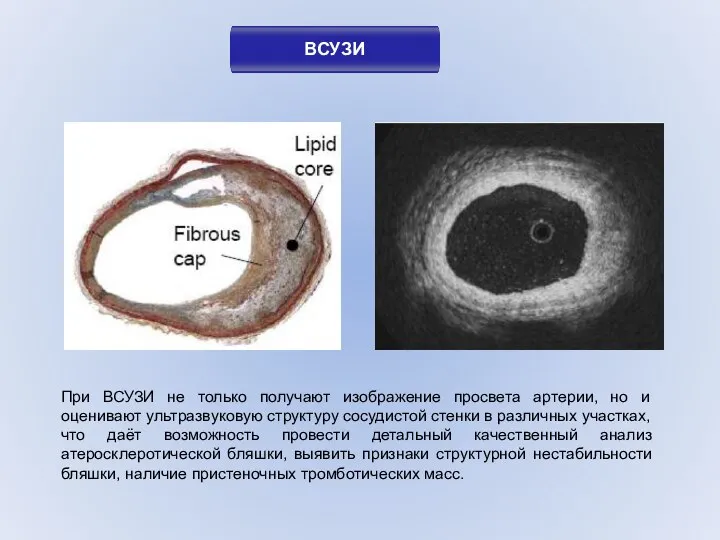 При ВСУЗИ не только получают изображение просвета артерии, но и оценивают