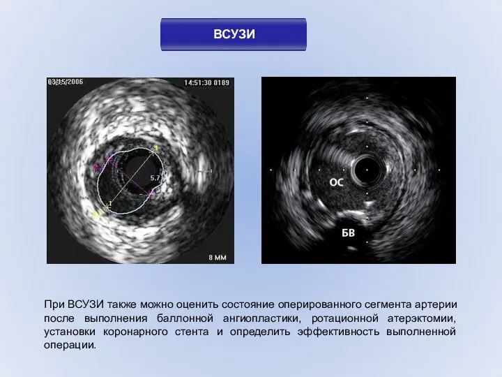 При ВСУЗИ также можно оценить состояние оперированного сегмента артерии после выполнения
