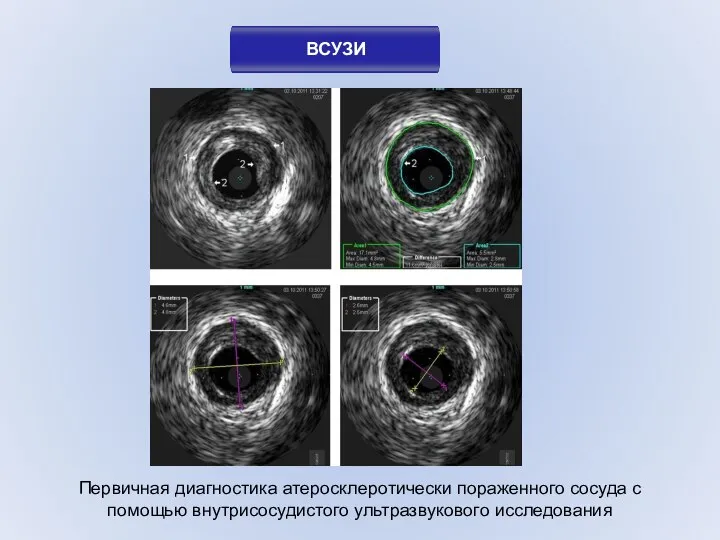 ВСУЗИ Первичная диагностика атеросклеротически пораженного сосуда с помощью внутрисосудистого ультразвукового исследования