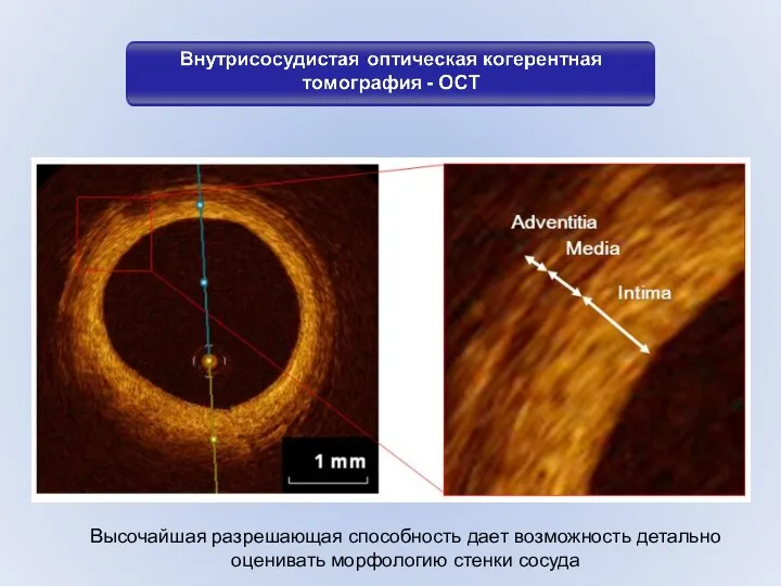 Высочайшая разрешающая способность дает возможность детально оценивать морфологию стенки сосуда