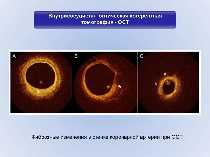 Фиброзные изменения в стенке коронарной артерии при OCT.
