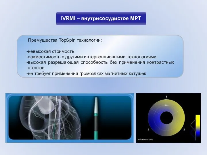 IVRMI – внутрисосудистое МРТ Премущества TopSpin технологии: невысокая стоимость совместимость с