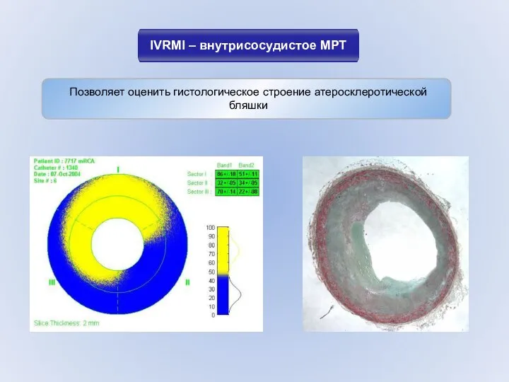 IVRMI – внутрисосудистое МРТ Позволяет оценить гистологическое строение атеросклеротической бляшки