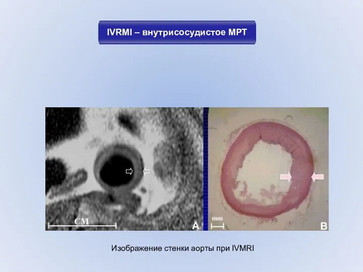 IVRMI – внутрисосудистое МРТ Изображение стенки аорты при IVMRI