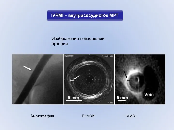 IVRMI – внутрисосудистое МРТ Ангиография ВСУЗИ IVMRI Изображение повздошной артерии