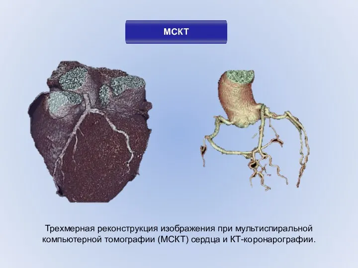 МСКТ Трехмерная реконструкция изображения при мультиспиральной компьютерной томографии (МСКТ) сердца и КТ-коронарографии.