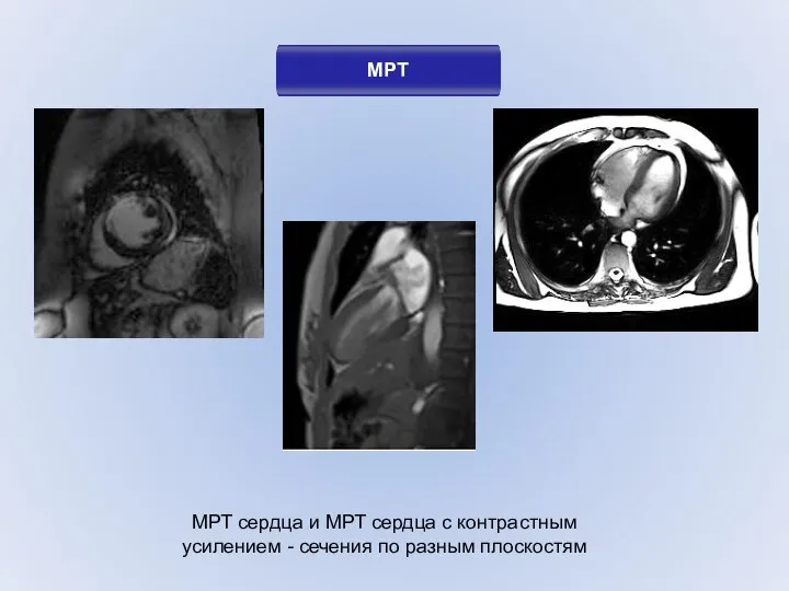 МРТ МРТ сердца и МРТ сердца с контрастным усилением - сечения по разным плоскостям