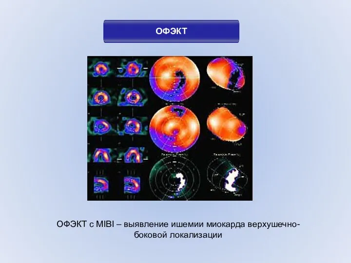 ОФЭКТ ОФЭКТ с MIBI – выявление ишемии миокарда верхушечно-боковой локализации