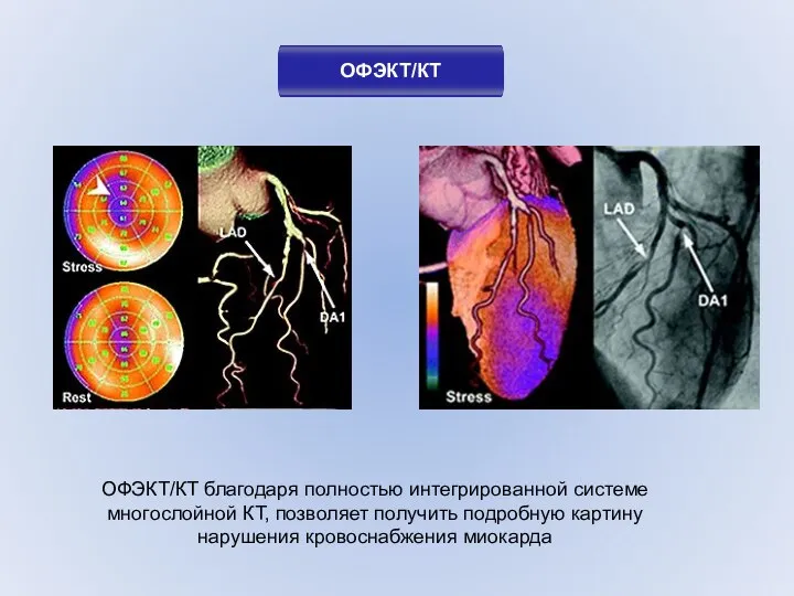 ОФЭКТ/КТ ОФЭКТ/КТ благодаря полностью интегрированной системе многослойной КТ, позволяет получить подробную картину нарушения кровоснабжения миокарда