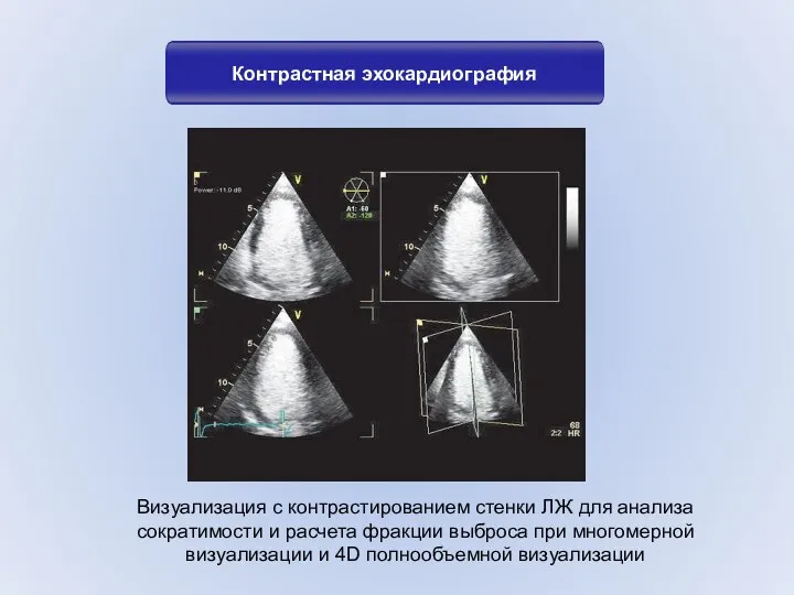 Контрастная эхокардиография Визуализация с контрастированием стенки ЛЖ для анализа сократимости и