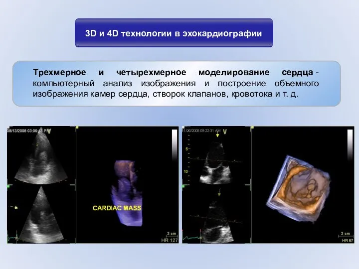3D и 4D технологии в эхокардиографии Трехмерное и четырехмерное моделирование сердца
