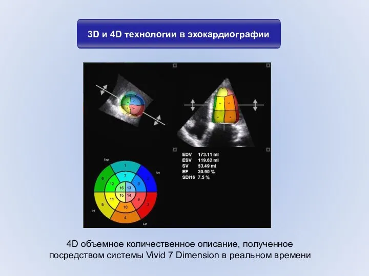 3D и 4D технологии в эхокардиографии 4D объемное количественное описание, полученное