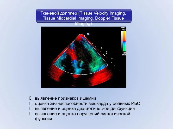 Тканевой допплер (Tissue Velocity Imaging, Tissue Miocardial Imaging, Doppler Tissue Imaging)