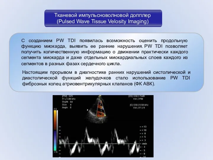 С созданием PW TDI появилась возможность оценить продольную функцию миокарда, выявить