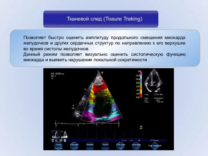 Тканевой след (Tissure Traking) Позволяет быстро оценить амплитуду продольного смещения миокарда