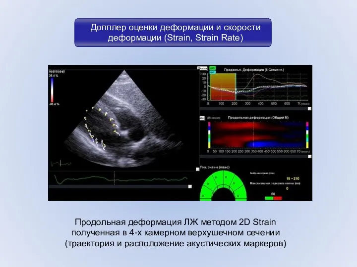 Допплер оценки деформации и скорости дефор­мации (Strain, Strain Rate) Продольная деформация