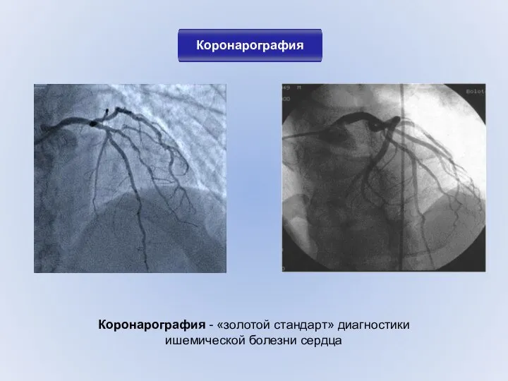 Коронарография Коронарография - «золотой стандарт» диагностики ишемической болезни сердца