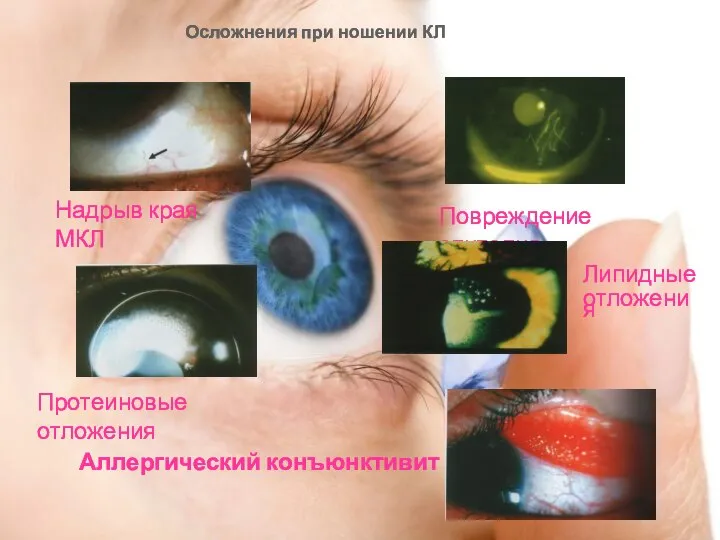 Осложнения при ношении КЛ Протеиновые отложения Надрыв края МКЛ Повреждение эпителия Аллергический конъюнктивит Липидные отложения